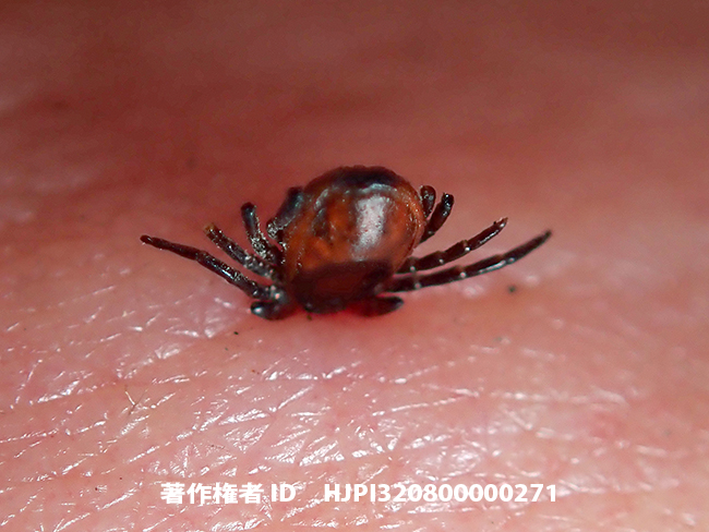 マダニに噛まれた　Ixodidae　sp.